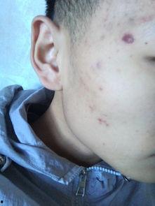 手挤痘痘视频,专业护理与风险警示